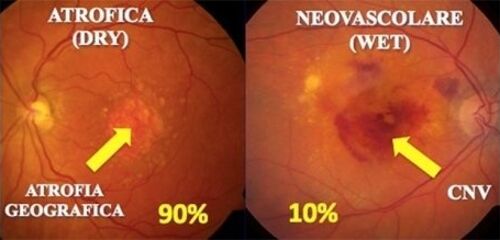 Degenerazione Maculare Atrofico Neovascolare